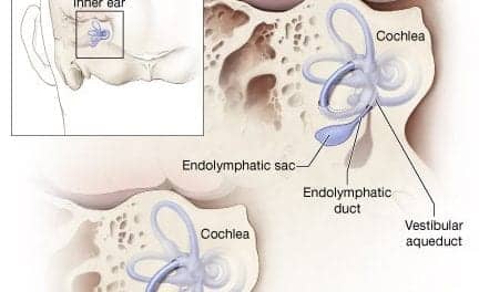 Study Reveals Underlying Cause of Enlarged Vestibular Aqueduct (EVA)